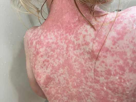 ¡Brote desbordado! Aumentan drásticamente casos de sarampión en Nuevo León bajo el gobierno de Movimiento Ciudadano