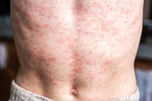 Brote de sarampión en México: Van 28 muertes y CDMX registra su primer deceso